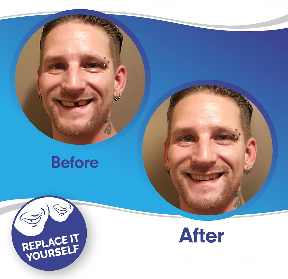 Snap-On Smile Veneers — Upper & Lower Teeth Cover Set 2